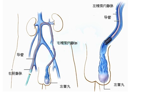 男性如何預防精索靜脈曲張