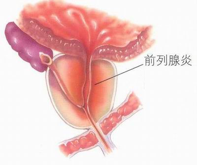 欽州前列腺炎的危害是什么